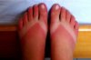 sunburnt%2Bfeet.jpeg